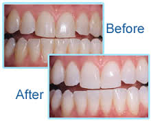 Teeth-Whitening-Tips